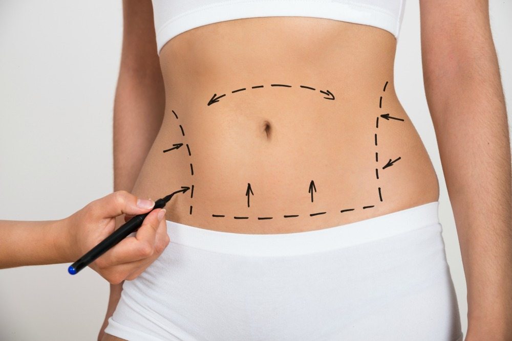  Tummy tuck surgery costs in India