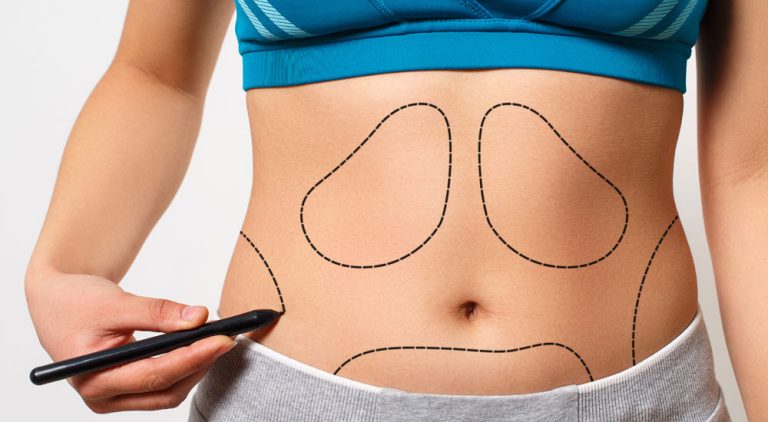 The best technique for fat removal from the body