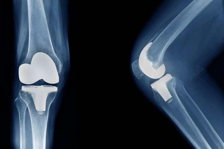 A New Hope for Those with Knee Problems: Robotic Knee Replacement
