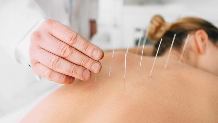 A GUIDE TO ACUPUNCTURE